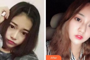 昆明同仁醫(yī)院醫(yī)療美容科李淵整形價(jià)格表附眼部修復(fù)案例展示