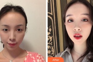 昆明醫(yī)科大學(xué)第一附屬醫(yī)院整形外科李逸松整形價格表附切開雙眼皮案例展示