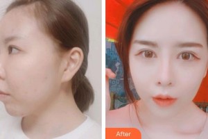 昆明華山眼科醫(yī)院和志清整形價(jià)格表附切開雙眼皮案例展示