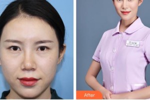 昆明華山眼科醫(yī)院李旭松整形價(jià)格表附內(nèi)切祛眼袋案例展示