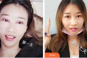 昆明愛爾眼科醫(yī)院楊建宇整形價(jià)格表附眼部綜合案例展示