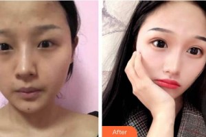 昆明華山眼科醫(yī)院袁天國整形價(jià)格表附切開雙眼皮案例展示