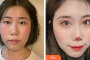 南寧?kù)诿泪t(yī)療美容診所徐贊正整形價(jià)格表附雙眼皮手術(shù)案例展示