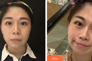 南寧思瑞醫(yī)療美容外科診所馬艷整形價格表附面部輪廓案例展示