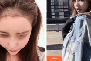 南寧悅星貞韓美容整形醫(yī)院郝帥整形價格表附植發(fā)案例展示