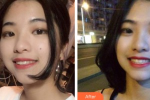 南寧嶺南口腔診所潘蛟南整形價(jià)格表附牙齒矯正案例展示