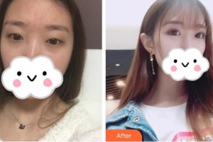 昆明普瑞眼科醫(yī)院岳以英整形價格表附定點雙眼皮案例展示