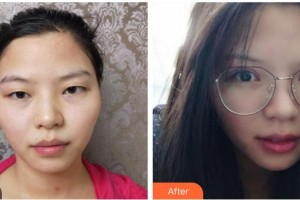 昆明愛爾眼科醫(yī)院甘凌整形價(jià)格表附眼部綜合價(jià)格表