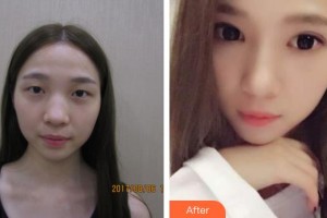 昆明普瑞眼科醫(yī)院葉計(jì)芬整形價(jià)格表附切開雙眼皮案例展示