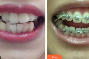 張前整形價(jià)格表附金屬托槽矯正案例展示