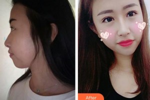 昆明愛爾眼科醫(yī)院管一沁整形價格表附眼部綜合案例展示