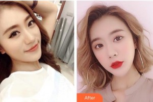 昆明愛爾眼科醫(yī)院瞿芳住院醫(yī)師整形價(jià)格表附開外眼角案例展示