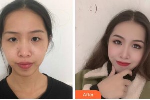 昆明拜博口腔醫(yī)院伍凱整形價格表附眼部案例展示　