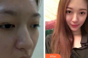 昆明眼科醫(yī)院詹行楷整形價(jià)格表附切開雙眼皮案例展示