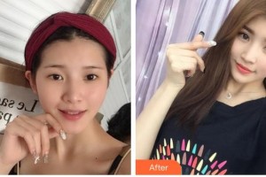 昆明普瑞眼科醫(yī)院梁東生整形價格表附切開雙眼皮案例展示