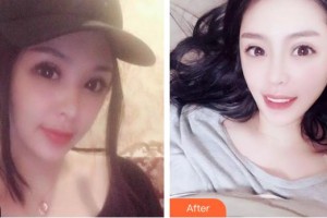 昆明拜博口腔醫(yī)院劉凡瑜整形價(jià)格表附牙齒隱形矯正案例展示