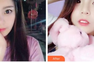 昆明拜博口腔醫(yī)院韓影整形價(jià)格表附牙齒隱形矯正案例展示