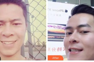 昆明拜博口腔醫(yī)院謝岳英整形價(jià)格表附金屬托槽矯正案例展示