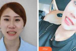 昆明拜博口腔醫(yī)院張雷整形價(jià)格表附金屬托槽矯正案例展示