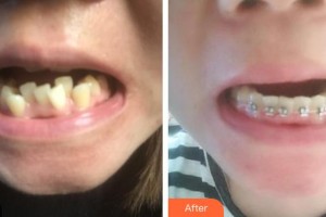 昆明拜博口腔醫(yī)院王海龍整形價格表附隱形托槽矯正案例展示