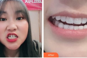 昆明愛雅仕口腔醫(yī)院尹二才整形價格表附牙貼面案例展示