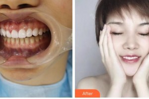 昆明市第一人民醫(yī)院星耀醫(yī)院邱偉整形價格表附冷光美白案例展示