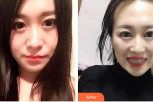 昆明先行口腔門診部秦泰整形價格表附冷光美白案例展示