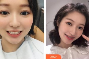 昆明尚愛韓美口腔門診部徐道美整形價格表附隱形托槽矯正案例展示