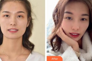 昆明醫(yī)科大學(xué)附屬口腔醫(yī)院億大口腔門診部張玉竹整形價格表附金屬托槽矯正案例展示