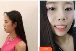 昆明愛齊口腔門診部蘇建輝整形價格表附金屬托槽矯正案例展示