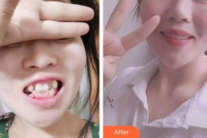 昆明拜博口腔醫(yī)院曹麗華整形價格表附金屬托槽矯正案例展示