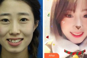 昆明醫(yī)科大學附屬口腔醫(yī)院億大口腔門診部滕芃妍整形價格表附牙齒隱形矯正案例展示