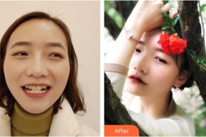 昆明醫(yī)科大學附屬口腔醫(yī)院億大口腔門診部魯志遠整形價格表附牙齒陶瓷矯正案例展示