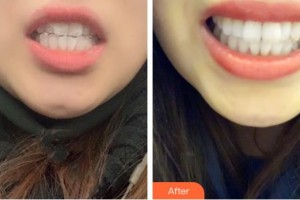 昆明愛雅仕口腔醫(yī)院馬宇飛整形價格表附隱形托槽矯正案例展示