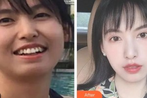 昆明尚愛韓美口腔門診部李滿坡整形價格表附牙齒隱形矯正案例展示