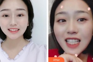 昆明藍橙口腔醫(yī)院馬清勇整形價格表附牙齒隱形矯正案例展示