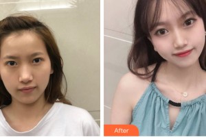 武漢涵美醫(yī)療美容門診部馮幼平整形價(jià)格表附自體脂肪填充案例展示