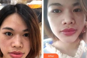 曲靖愛爾眼科醫(yī)院龔永祥整形價(jià)格表附激光去眼袋案例展示