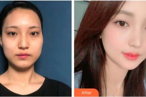 曲靖市第二人民醫(yī)院眼科楊林紅整形價(jià)格表附眼部綜合案例展示