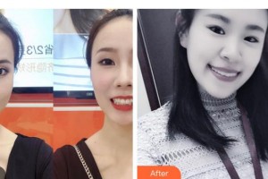 曲靖口腔醫(yī)院聶慶森整形價(jià)格表附牙齒隱形矯正案例展示