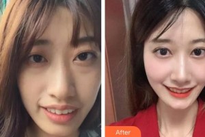 曲靖口腔醫(yī)院閻川整形價(jià)格表附牙齒陶瓷矯正案例展示