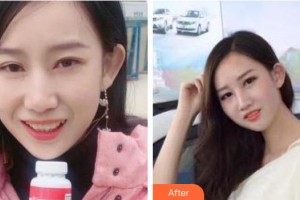 曲靖卓美口腔門診部代金晶整形價(jià)格表附金屬托槽矯正】案例展示