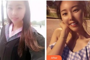 玉溪市人民醫(yī)院皮膚醫(yī)學(xué)美容外科李曉東整形價(jià)格表附金屬托槽矯正案例展示