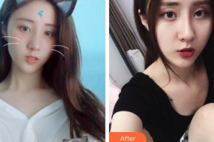 玉溪市人民醫(yī)院皮膚醫(yī)學(xué)美容外科矣平整形價(jià)格表附激光祛斑案例展示