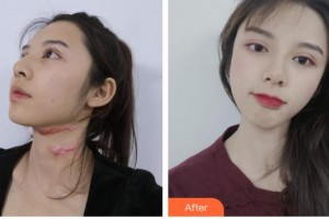 玉溪市人民醫(yī)院皮膚醫(yī)學美容外科胡瑚整形價格表附微創(chuàng)疤痕修復案例展示