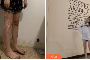 玉溪左醫(yī)生整形美容門診部張文宣整形價格表附微創(chuàng)疤痕修復案例展示