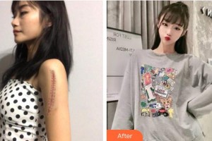 玉溪左醫(yī)生整形美容門診部傅家友整形價格表附手術祛疤案例展示