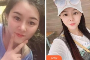 玉溪愛爾眼科醫(yī)院林泉整形價格表附內(nèi)切祛眼袋案例展示