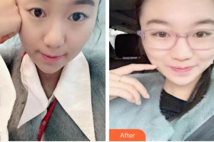 玉溪華山眼科醫(yī)院楊永福整形價格表附埋線雙眼皮案例展示