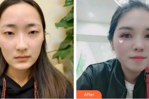 昭通愛麗諾醫(yī)療美容門診部吳鳳枝整形價(jià)格表附眼部綜合案例展示